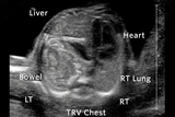 CDH Congenital Diaphragmatic Hernia Ultrasound