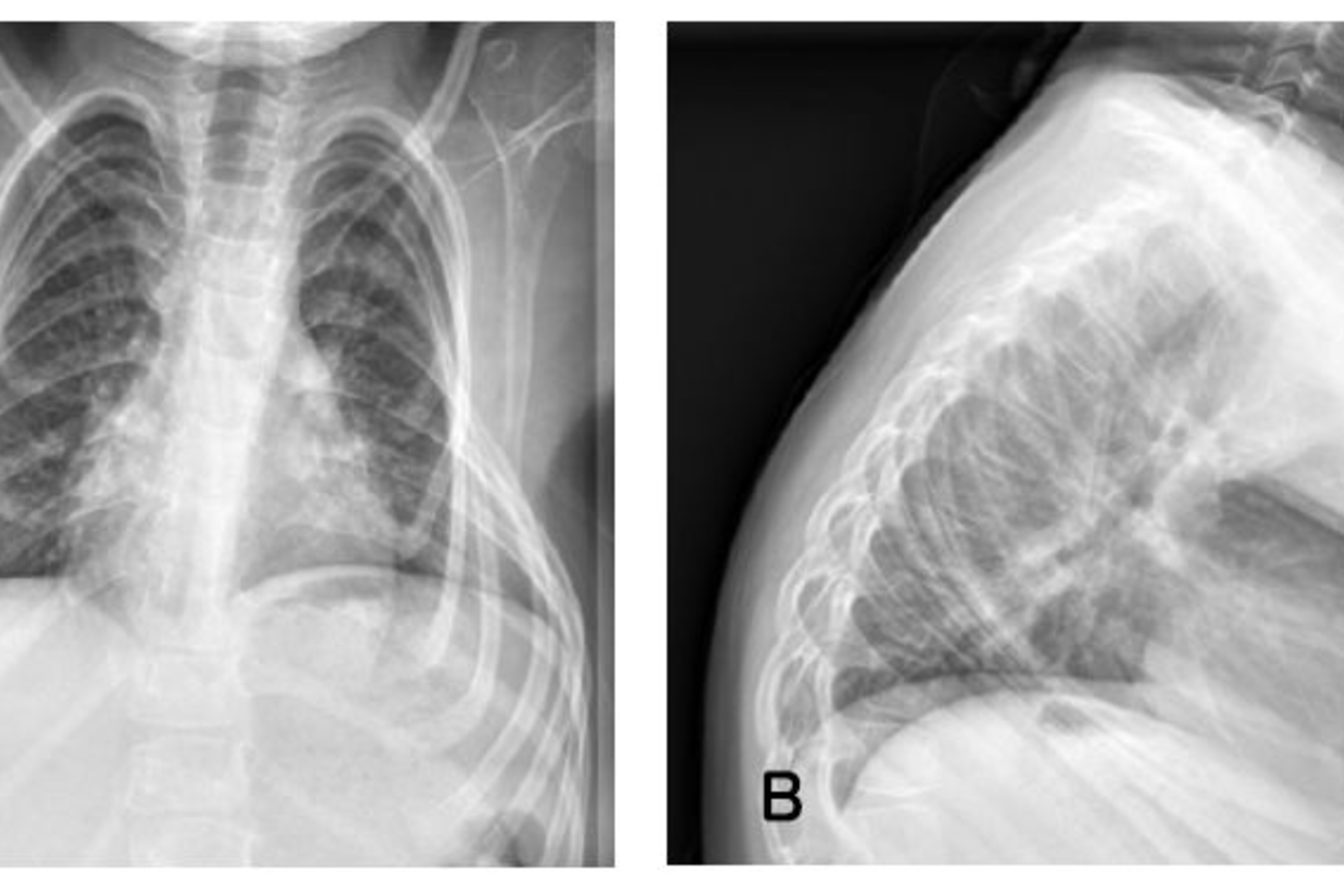 Case Study: 4-Year-Old with Spinal Muscular Atrophy Type 2 | Children's ...