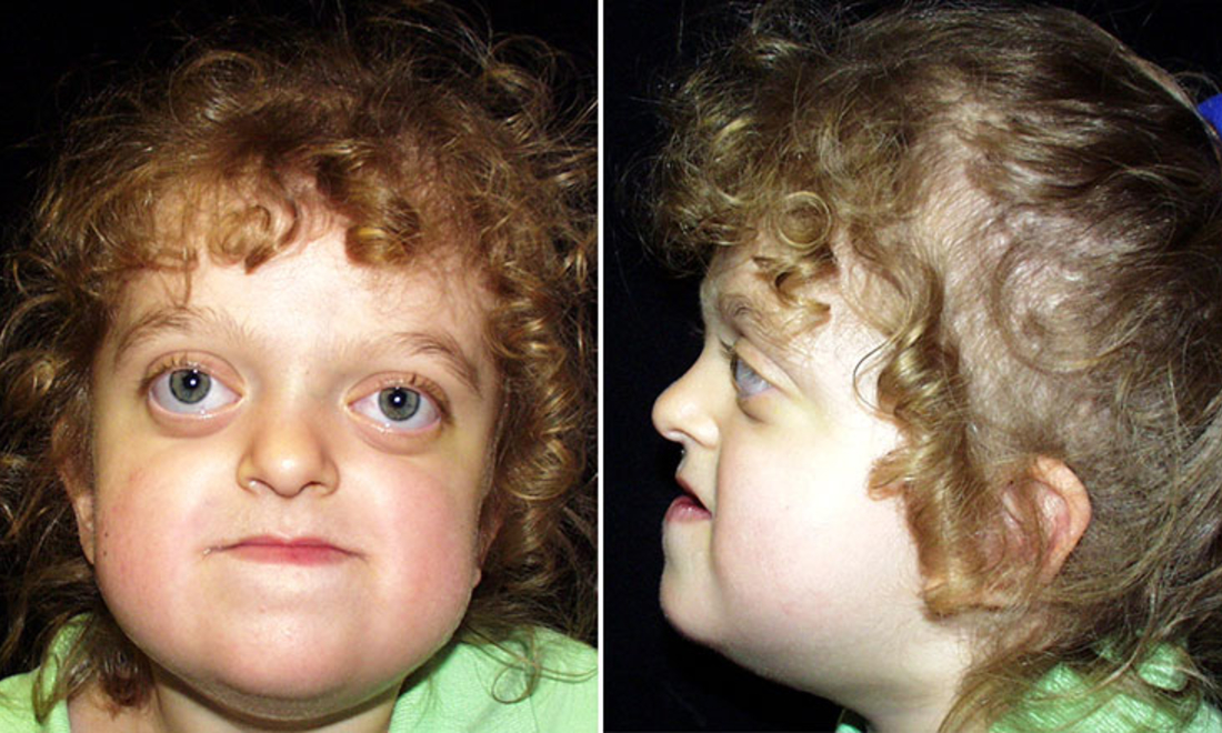 Pfeiffer Syndrome | Children's Hospital of Philadelphia