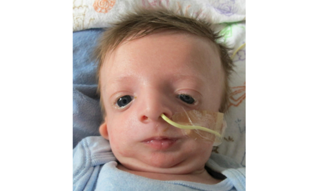 Neonatal Craniofacial Program | Children's Hospital of Philadelphia