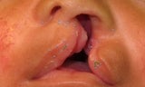 A left unilateral complete cleft lip is repaired with the Millard technique.