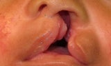 A left unilateral complete cleft lip is repaired with the Millard technique.