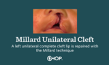 A left unilateral complete cleft lip is repaired with the Millard technique.