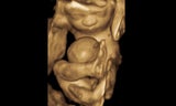 ultrasound 3D fetal mri