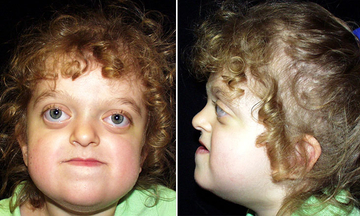 Pfeiffer Syndrome 