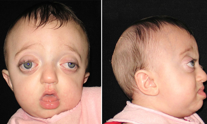 Pfeiffer Syndrome | Children's Hospital of Philadelphia