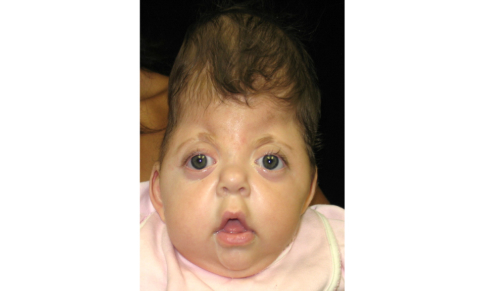 Neonatal Craniofacial Program | Children's Hospital of Philadelphia