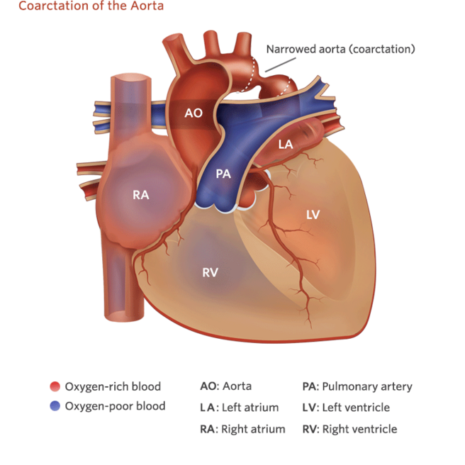 Coarctation of the Aorta Illustration