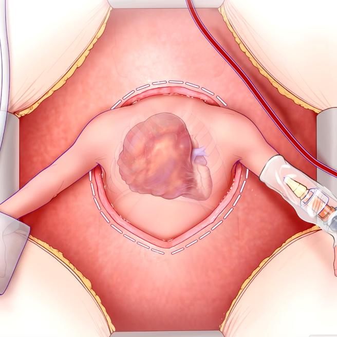 arley procedure illustration. 