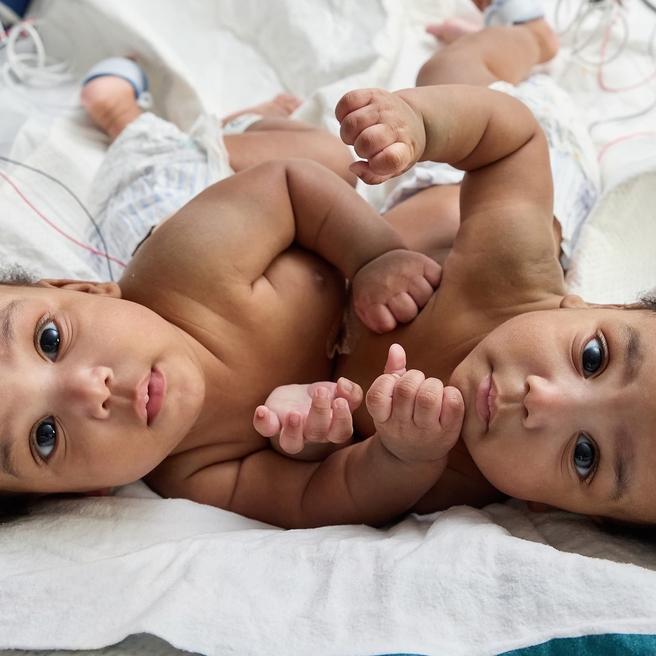 Birth and Separation of Conjoined Twins: Amari and Javar