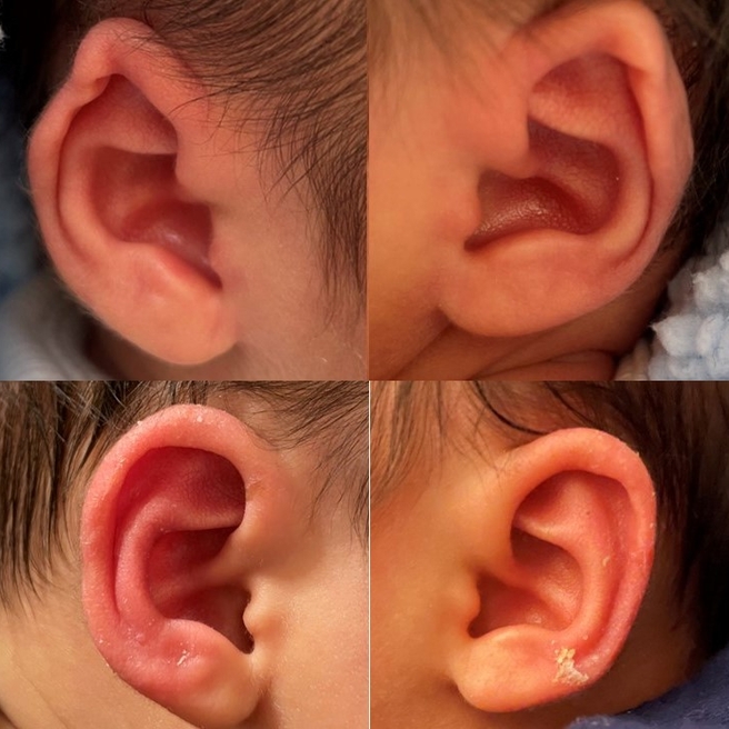 infant baby uncommon ear shape before and after ear molding