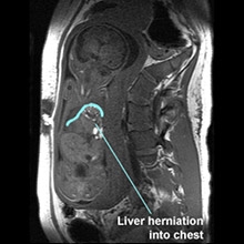 mri cdh hernia diaphragmatic congenital fetal chop herniation liver ultrafast chest edu