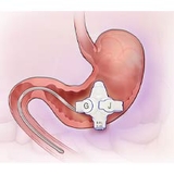 GJ tube placed in the stomach with J tube extending into the small intestine.