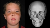 craniofacial fibrous dysplasia boy front view