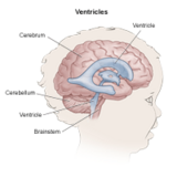 Intraventricular hemorrhage illustration