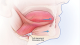 Cuff placement/Stimulation Site