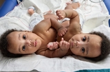 Birth and Separation of Conjoined Twins: Amari and Javar