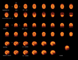 SPECT Brain Scan Image