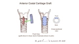 anterior costal cartilage graft