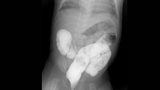 Barium Enema Image