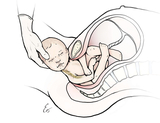 Brachial Plexus Causes Image