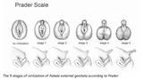 Prader Scale - Figure 1