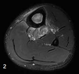 Cross-section X-ray of the tibia