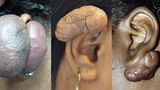 Ear Keloids Image