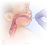 illustration showing placement of a replogle tube