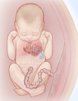 Fluid-filled macrocystic lesions with shunt