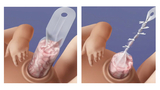 gastroschisis repair (gastroreduction)