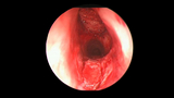 glottic stenosis treatment