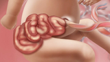 gastroschisis illustration