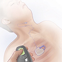 Hypoglossal nerve stimulator