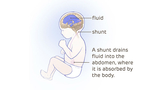 Illustration of fetal hydrocephalus