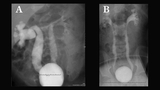 VCUG images at infant age and 10 years old