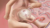 omphalocele illustration