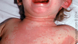 kawasaki disease