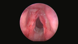 laryngeal trauma