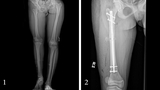 limb lengthening xray images