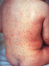 measles