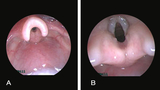 microlaryngoscopy