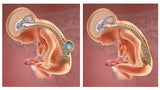 before and after spina bifida repair