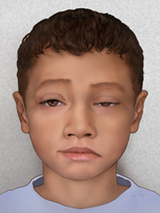 ocular myasthenia gravis illustration