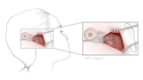 Cochlear Implant Fixation - Thumbnail