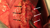 pancreatic-fig 3