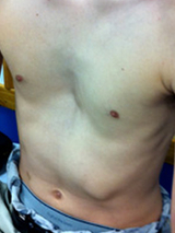 pectus excavatum