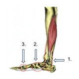 fhl tendonitis photo