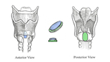 sutureless posterior graft