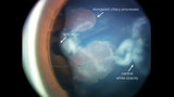 posterior lense surface